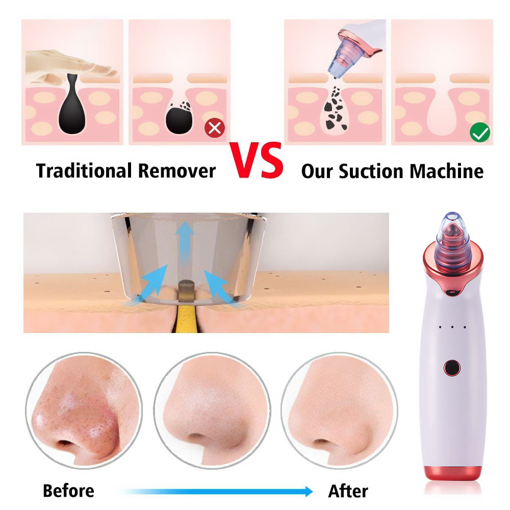Electric Blackhead Vacuum – Deep Pore Cleanser